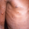 Primeiro caso de varíola dos macacos é confirmado no RS