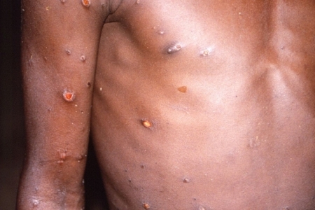 Primeiro caso de varíola dos macacos é confirmado no RS